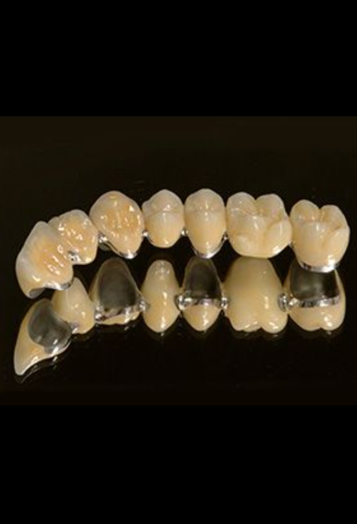Dental bridge treatment at Dentovate