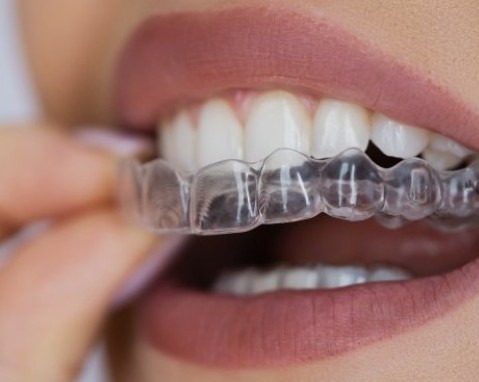 Clear aligners at Dentovate