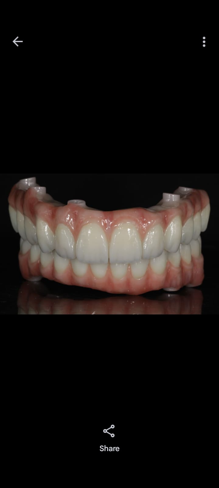 Dental implants at Dentovate