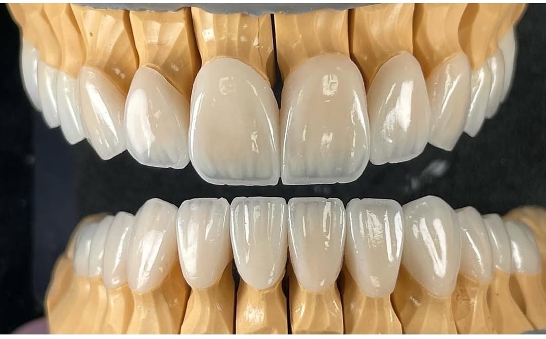 Milled dental restorations on a lab rack
