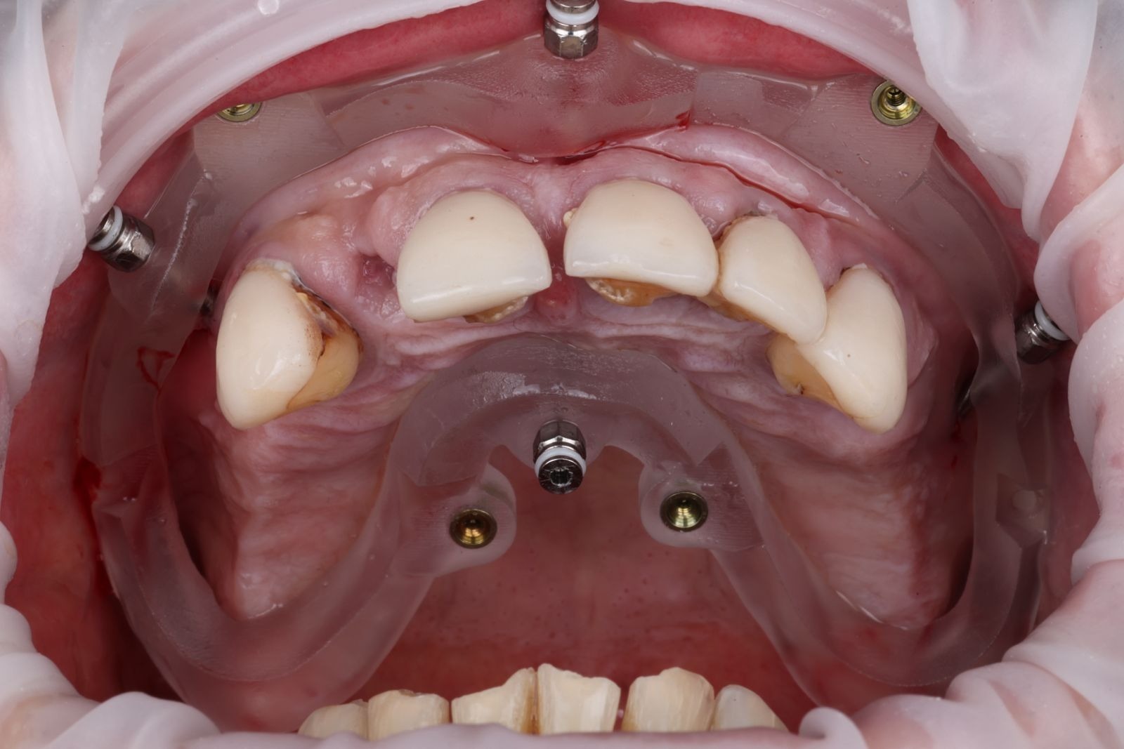 Milled dental restorations on a lab rack