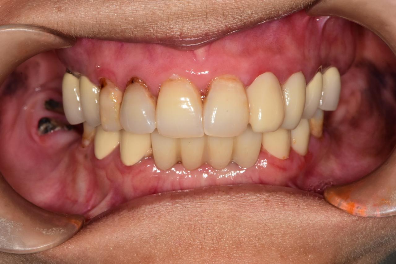 Milled dental restorations on a lab rack