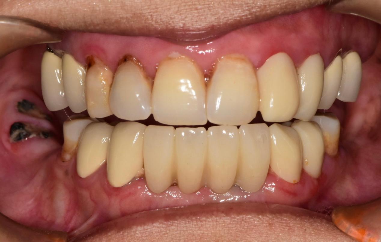 Milled dental restorations on a lab rack