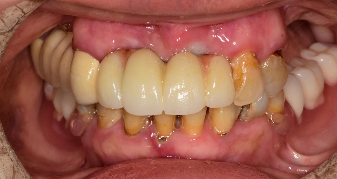 Milled dental restorations on a lab rack