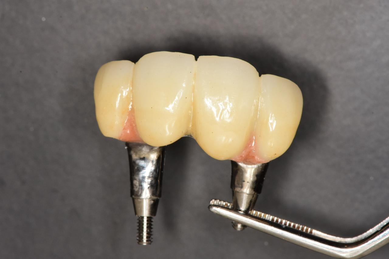 Milled dental restorations on a lab rack