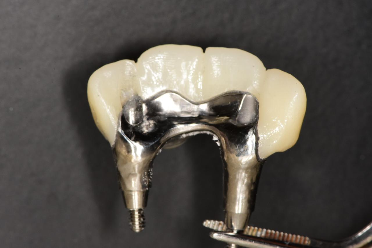 Milled dental restorations on a lab rack